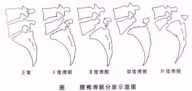 你的腰骨折过吗,你的腰椎