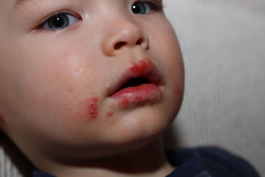 北京疾控手足口病进入高发期,中国疾控中心手足口病健康提示