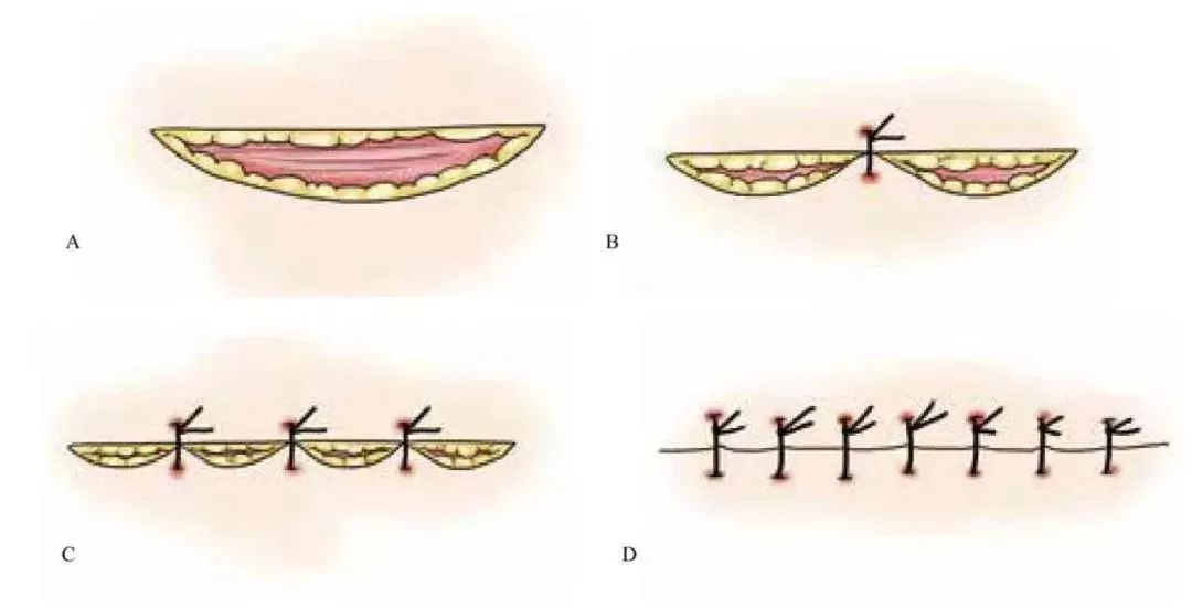3分钟get:真正的外科缝合秘籍