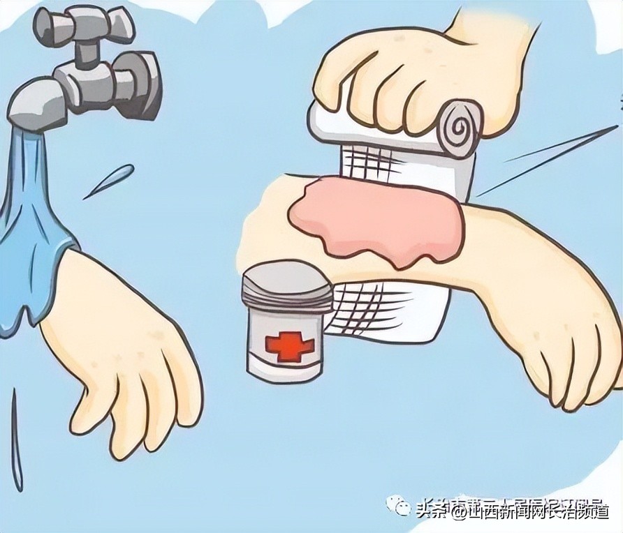 长治市第二人民医院：发生烧烫伤不要慌，正确急救处理办法来了