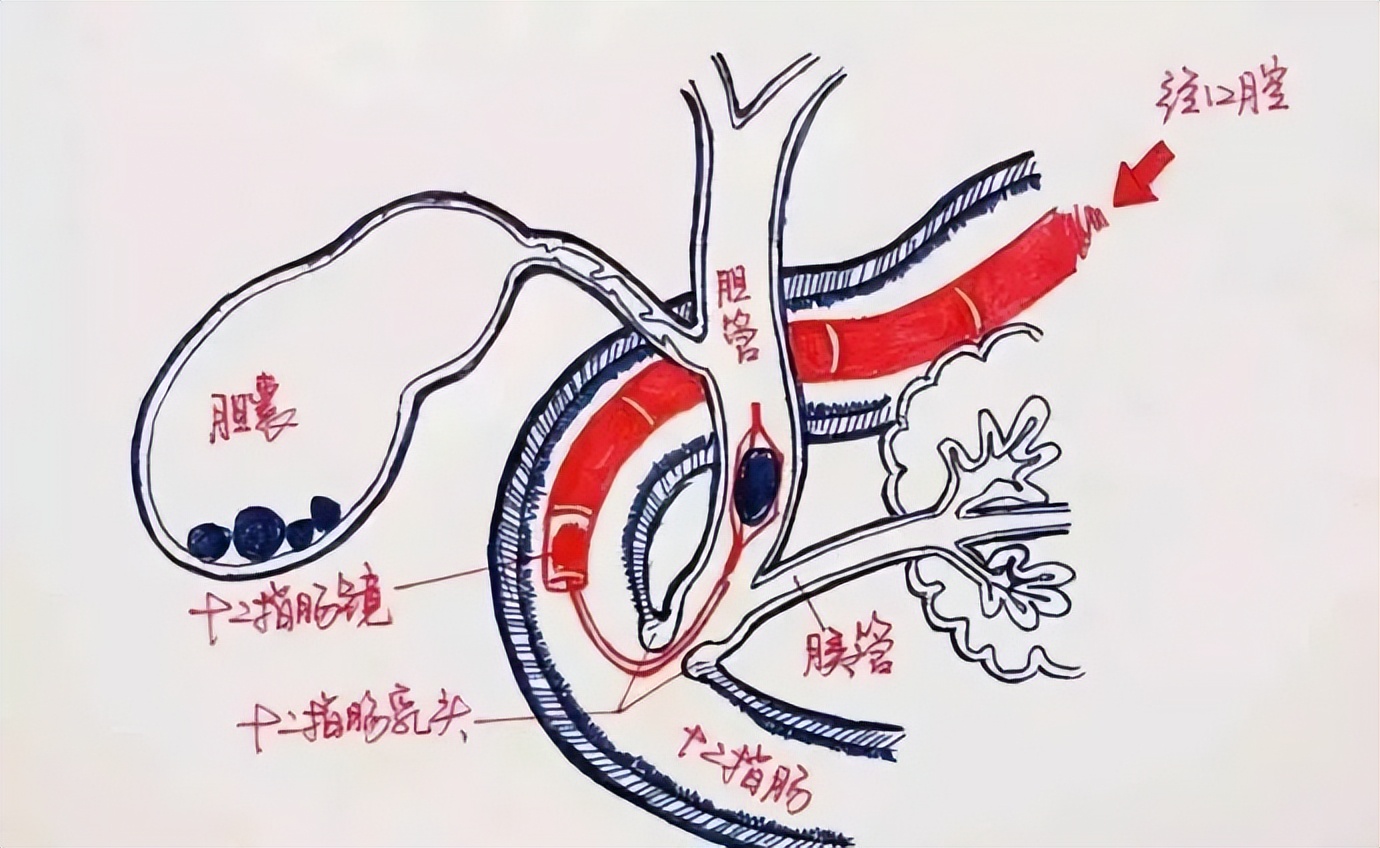 科普不可忽视的胆囊结石,胆管结石科普视频