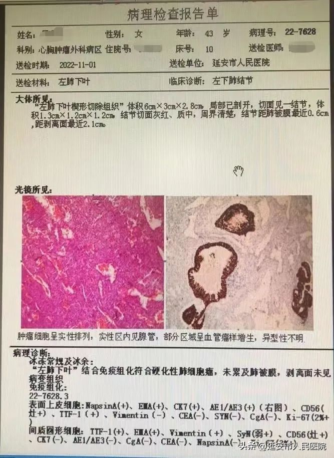 硬化性肺细胞瘤的治疗和预后,硬化性肺细胞瘤36例临床分析