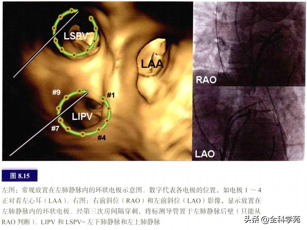 连接左心房的是肺静脉吗,左心房与肺静脉解剖