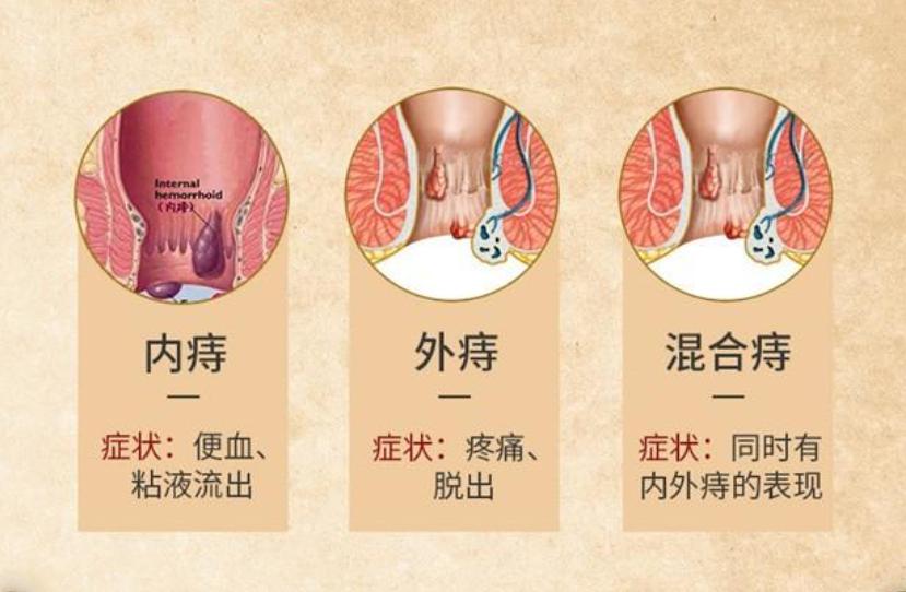 痔疮和肛周湿疣,肛周湿疣和痔疮先治哪个