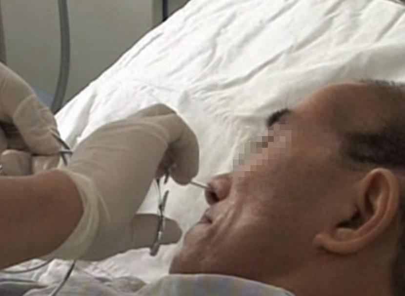 临终脱水、疼到痉挛，却被妻子强制插胃管，45岁丈夫呕出浓黑血液