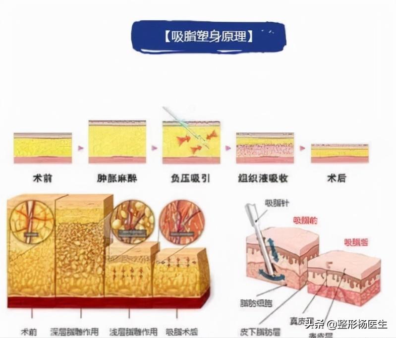 怎么预防大腿吸脂凹凸,大腿吸脂如何避免脂肪栓塞
