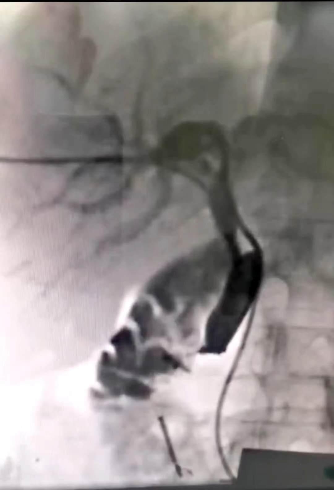 超声介入流程及注意事项,超声介入和b超的区别