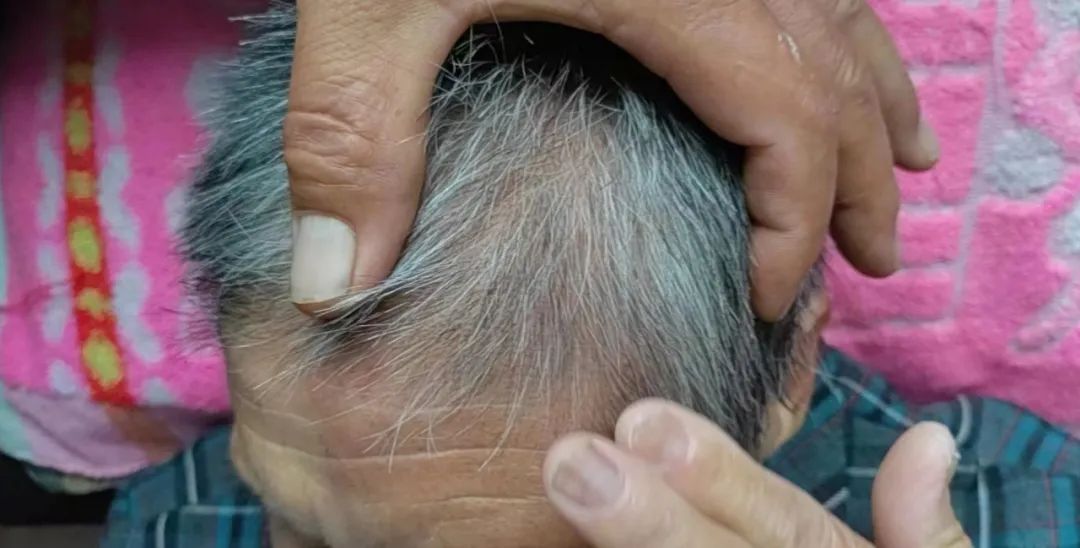 疱疹消失了但是还是痛怎么办,疱疹晚上疼痛难忍