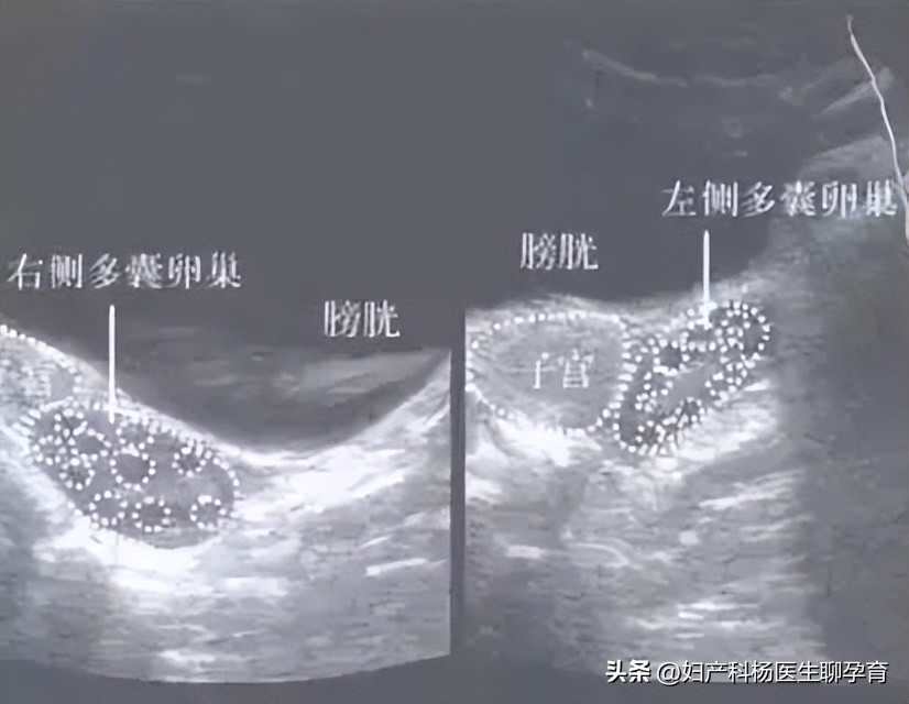 促排卵过度刺激会怎么样,促排卵对卵巢的损害