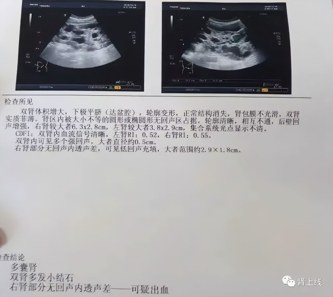 一家接连患尿毒症，是怎么回事？了解最常见的遗传性肾病-多囊肾