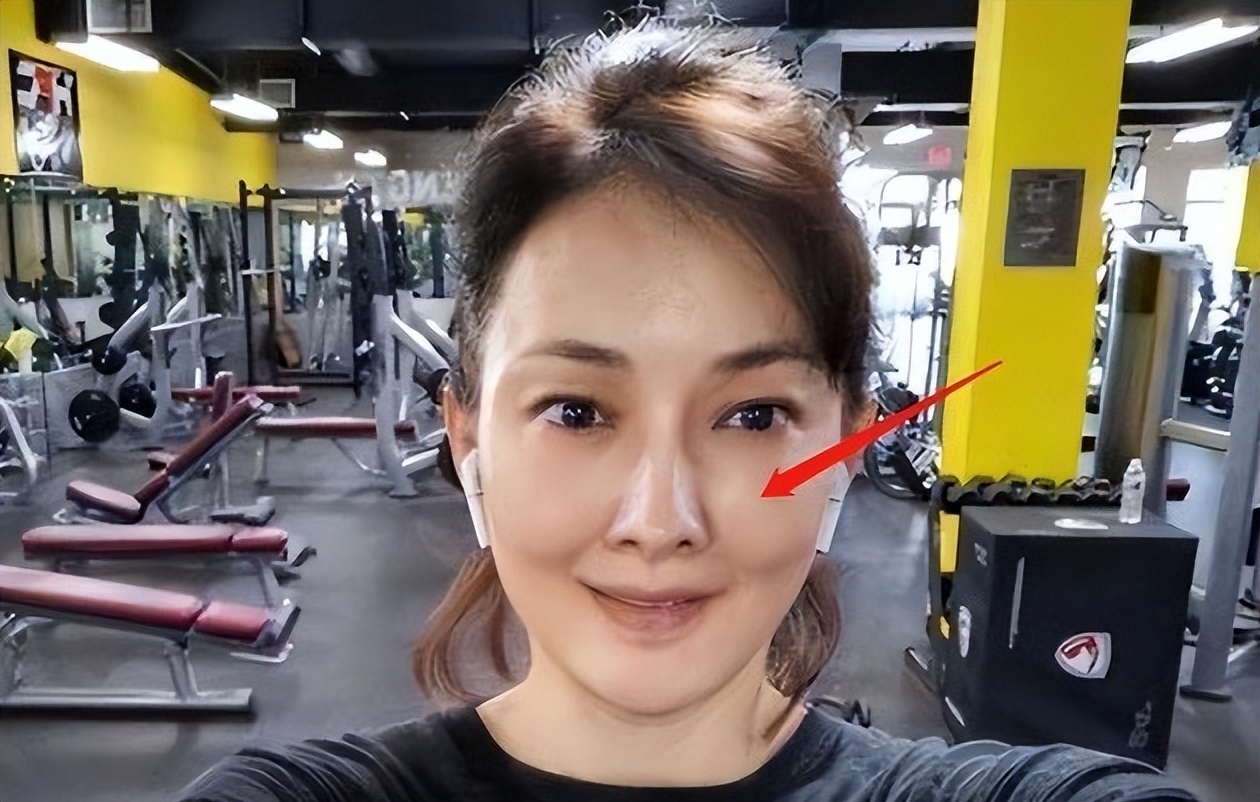 明星下颚骨整容后遗症,脸像鞋拔子怎么改善