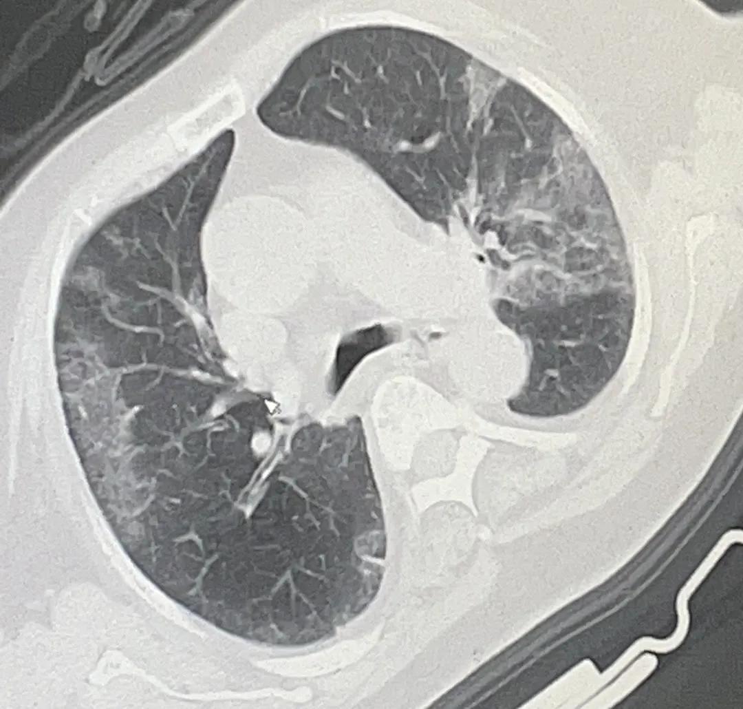 老人新冠一直发烧要警惕,老人新冠持续发低烧37.1-37.5要警惕