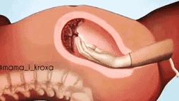 医生把胎盘拿走了,21天胎盘留体内