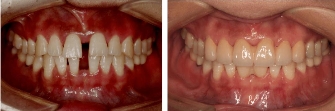 收牙缝使牙缝变大了怎么办,怎样可以避免牙缝越来越大