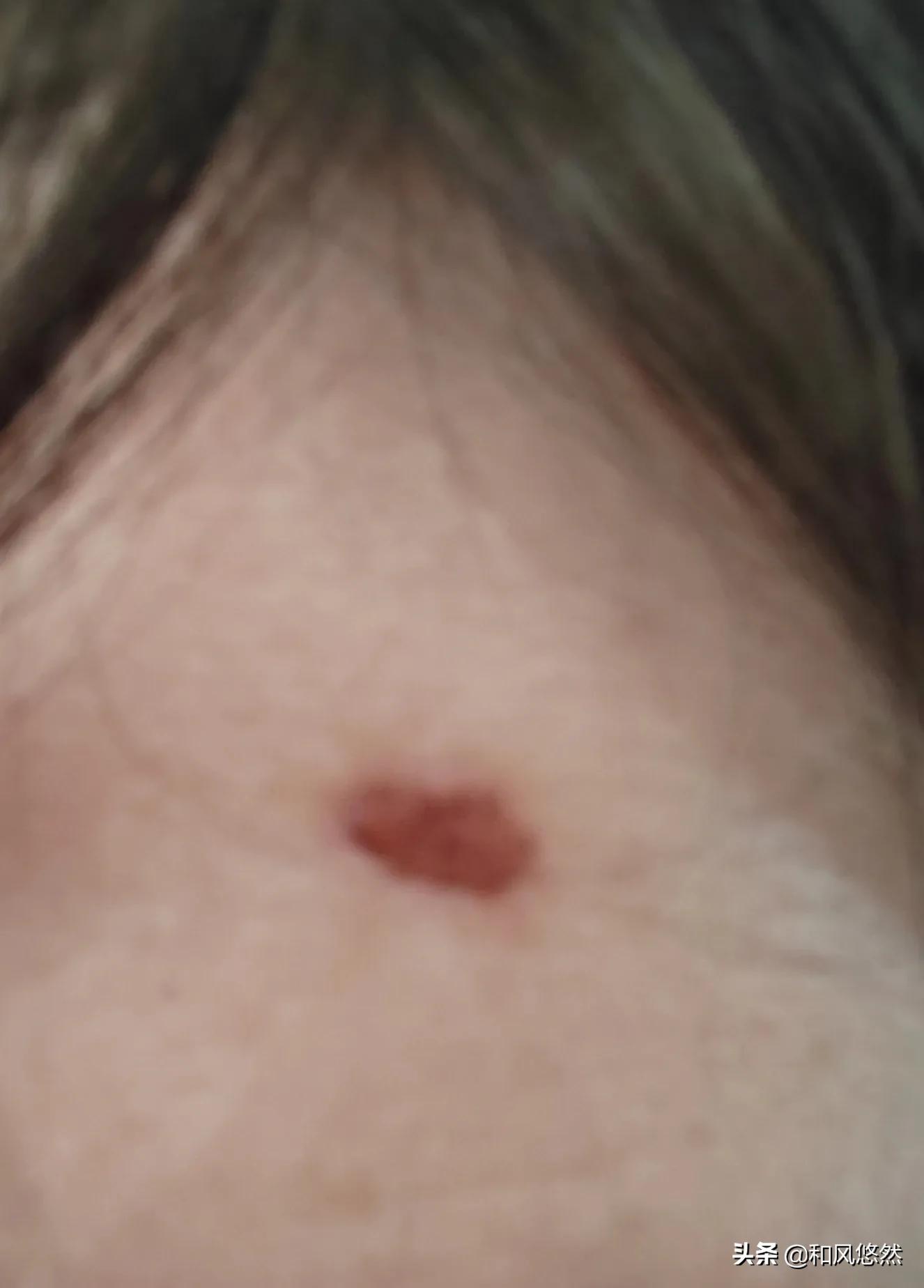 祛斑真实有效推荐,快速祛斑易出现哪些副作用