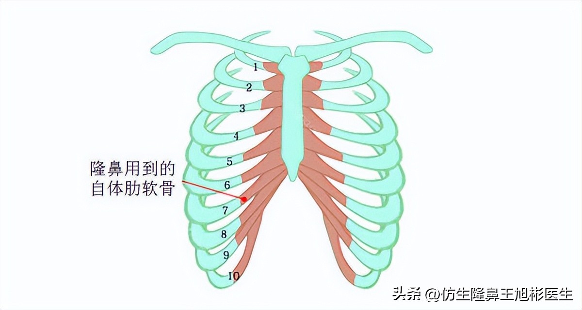 耳软骨隆鼻和肋软骨隆鼻图片对比,耳软骨隆鼻和假体耳软骨隆鼻
