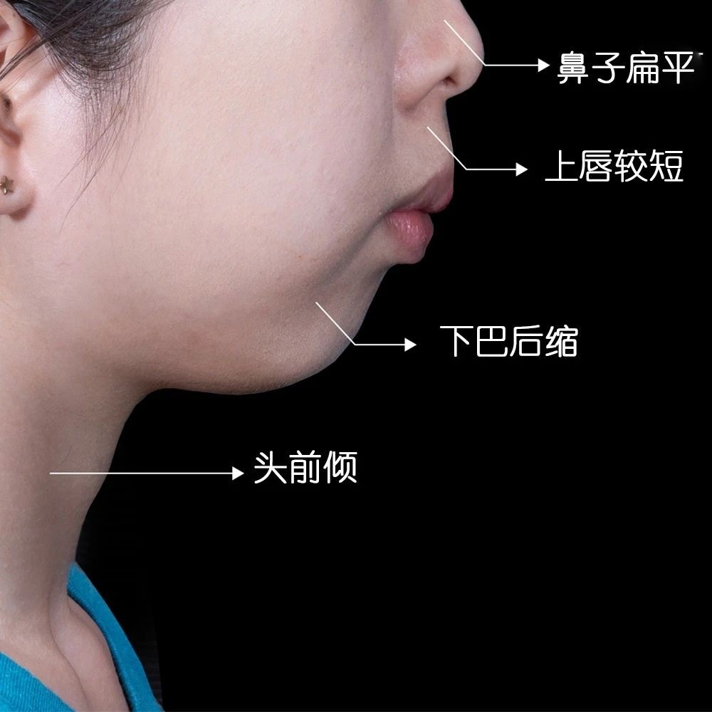下巴短和后缩怎么变美,下巴后缩怎么矫正嘴尖