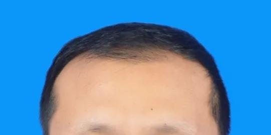 男士植发过来人真实感受,16000字讲述植发真实感受