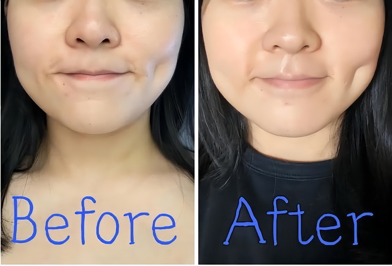 热拉提除了紧致还有什么效果,40岁做热拉提效果好吗