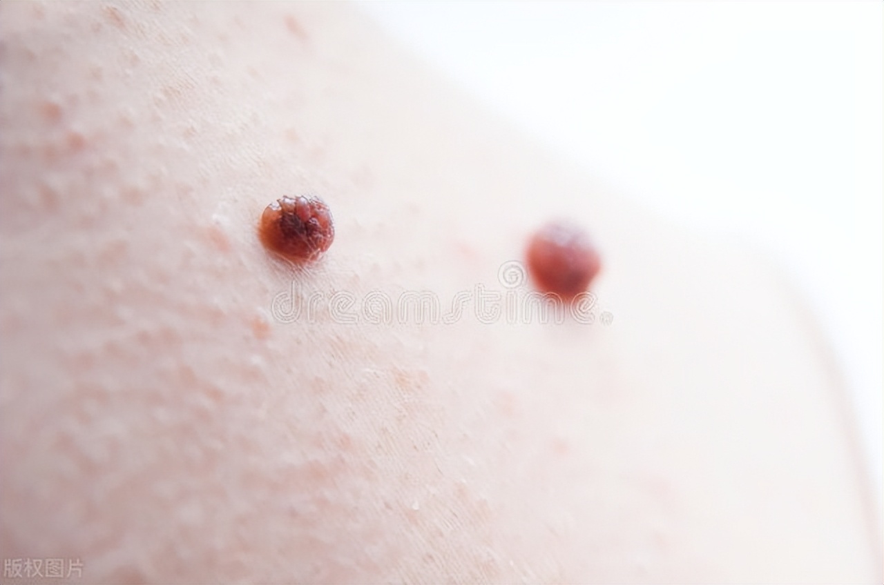 皮肤长小肉球是什么症状,皮肤长小疙瘩小肉球怎么弄