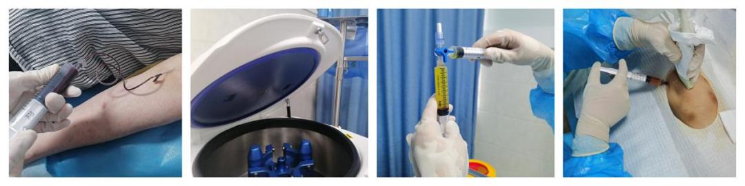 关节prp治疗要打麻药吗,风湿性关节炎prp