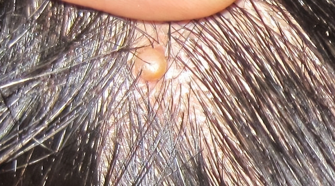 头皮上总是长疙瘩和脓包如何根治,头皮上长疙瘩脓包怎么回事