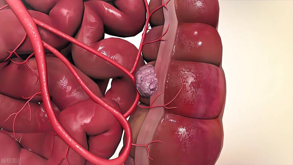 直肠癌晚期一般有什么症状？