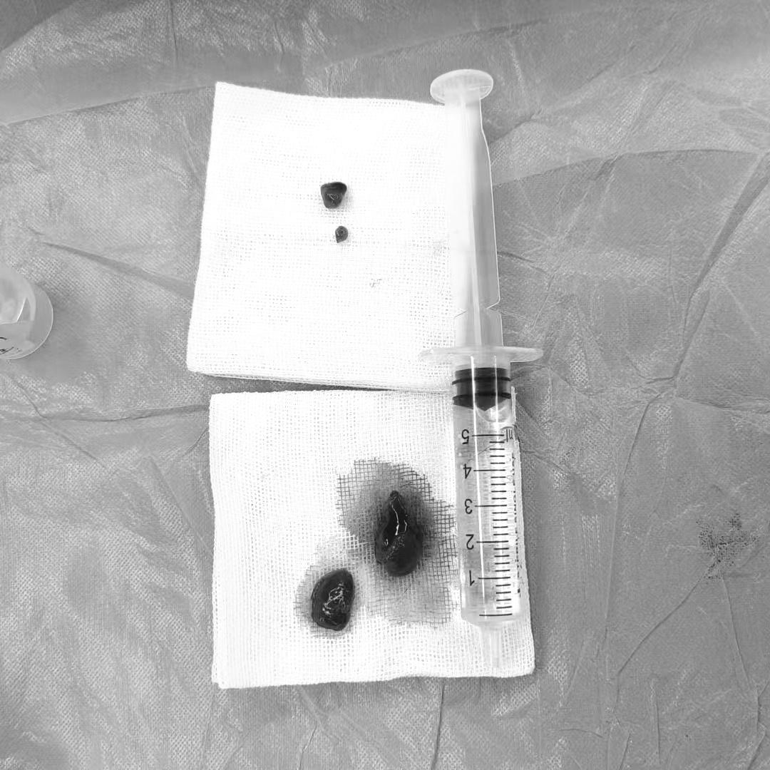 双肺梗阻,双肺阻塞