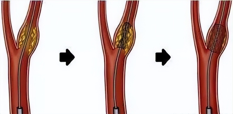 下肢动脉硬化多发斑块形成,下肢动脉硬化闭塞症治疗多少钱