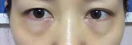 眼袋和卧蚕有什么区别？怎样去除显老的眼袋？这篇文章给你答案