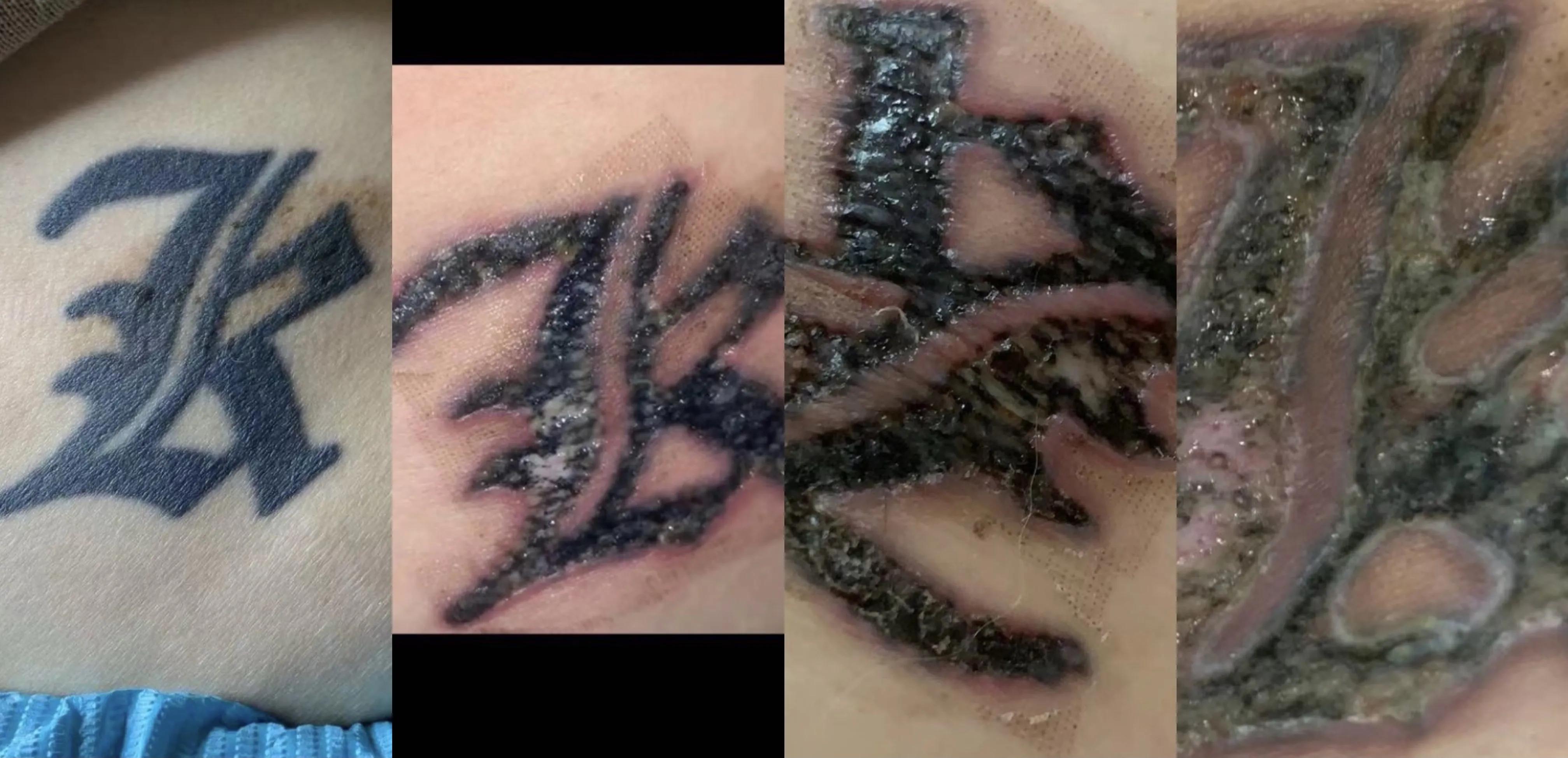 洗纹身真的不是一般人能承受的,洗纹身真的要下很大的决心