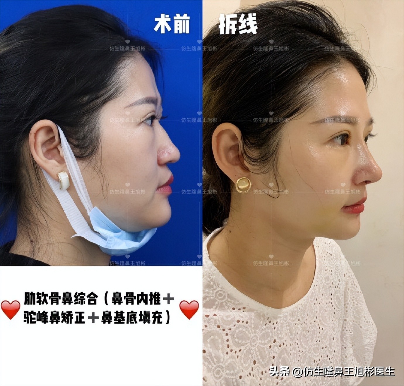 鼻头部位整形,鼻头圆钝高鼻梁整形案例