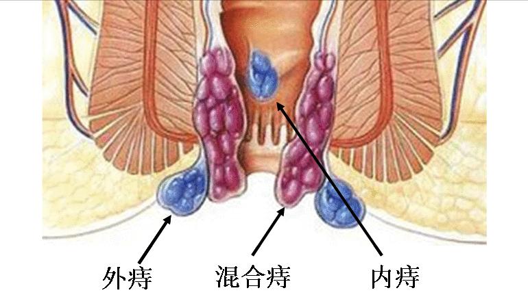 女性哪些生活习惯会引发肛裂,18岁女孩肛裂是什么毛病引起的