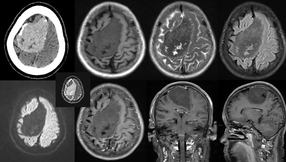 骨软骨瘤mri,颅骨血管瘤mri表现