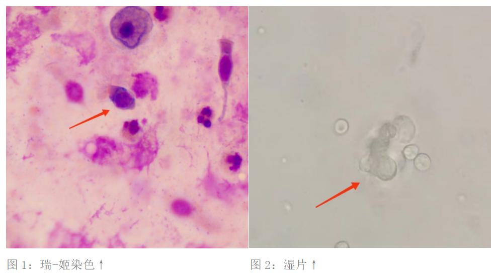 无端发热咳痰,医生:第一次见这种感染!患者可能吃到了蟑螂屎