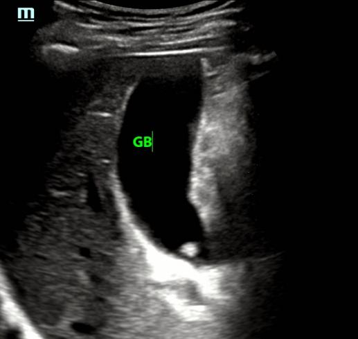 超声所见正常范围准确吗,超声看不清楚