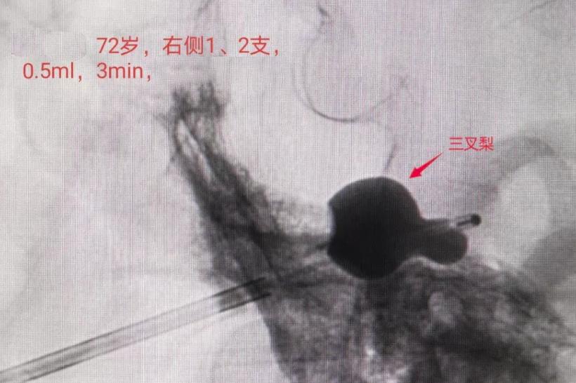 小球囊压三叉神经,微球囊治疗三叉神经痛不良反应