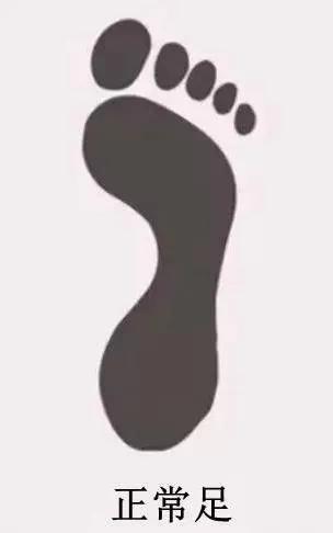 扁平足发病机制,扁平足诊断标准示意图