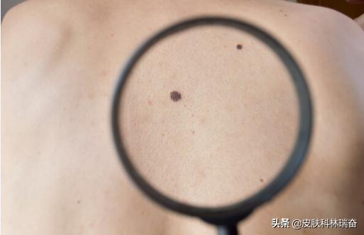 脸上点痣留下很明显的红印怎么办,脸上点痣后的疤痕怎么处理