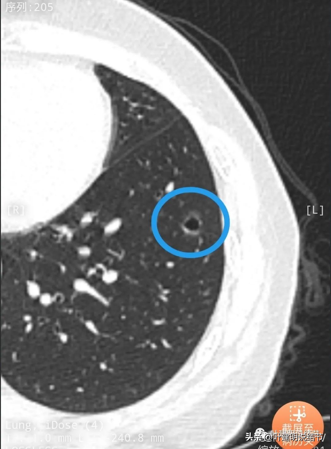 辽宁省肺结节手术哪家医院好,辽宁肺结节手术医院