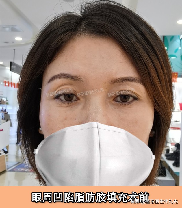 眼窝凹陷怎么填充不会肿眼泡,眼窝脂肪填充鼓包补救方法是什么