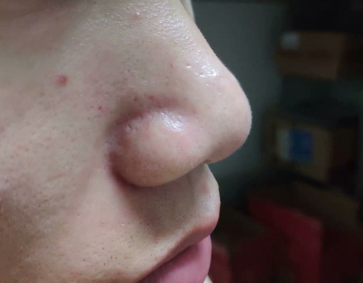 为什么鼻子可以挤出很大的黑头,用夹子挤出鼻子黑头