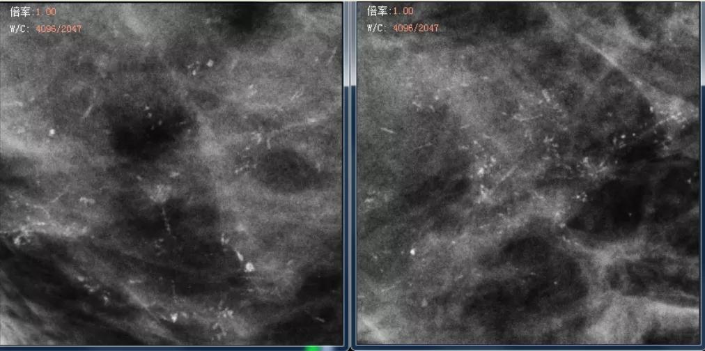 联合检查达到的效果,合并导管原位癌