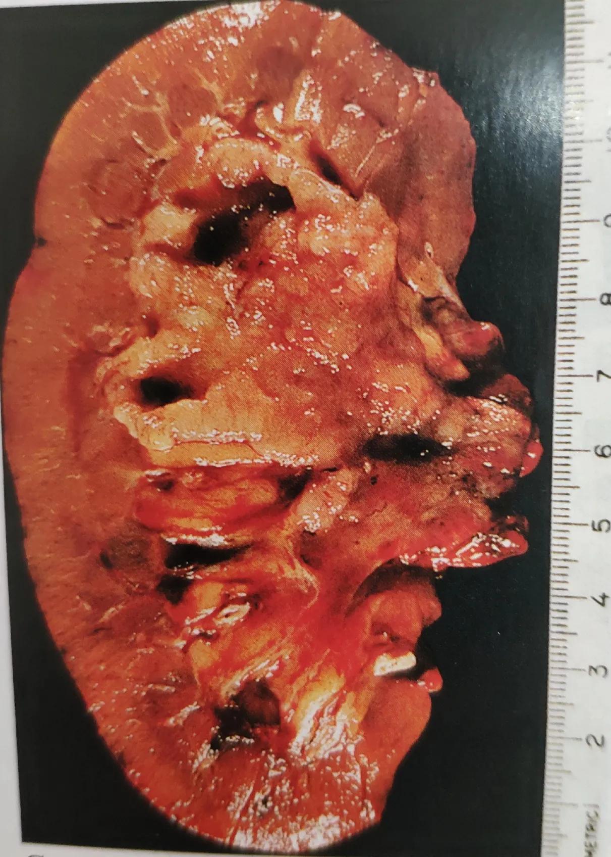 体检发现肾上有肿瘤怎么办,体检肾有个肿块是怎么回事