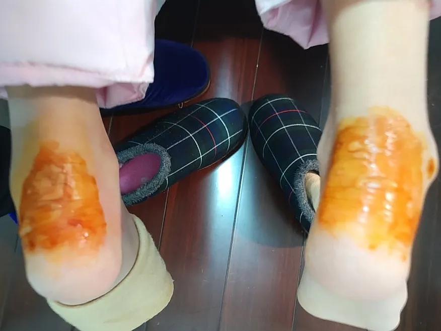 脚后跟红肿皮干,脚后跟红肿用什么药治疗