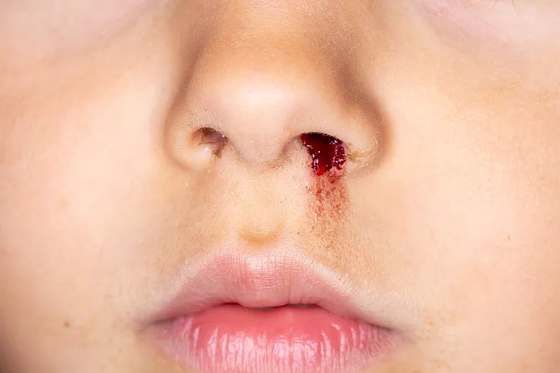 孩子流鼻血怎么办？这样做可以快速止血！有需要的快收藏