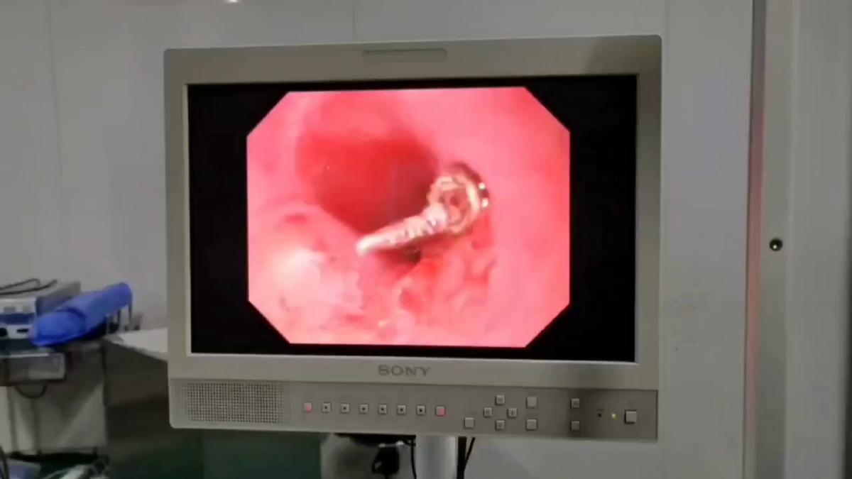 一例无痛小儿食道异物取出术