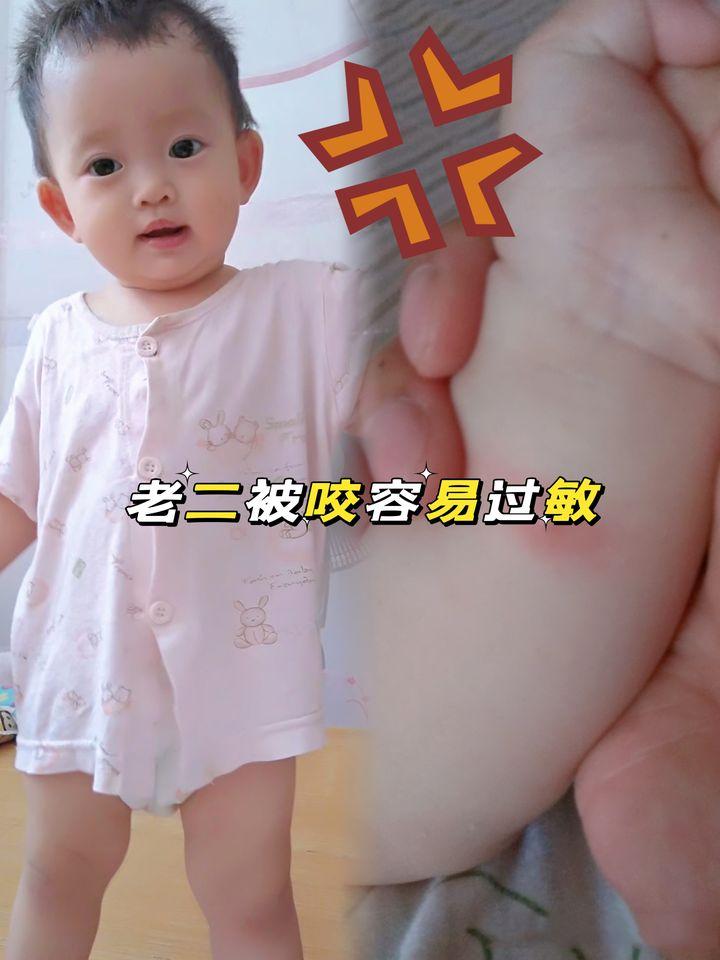 宝宝被蚊虫叮咬后有什么好办法吗,孩子被蚊虫叮咬了生活小妙招