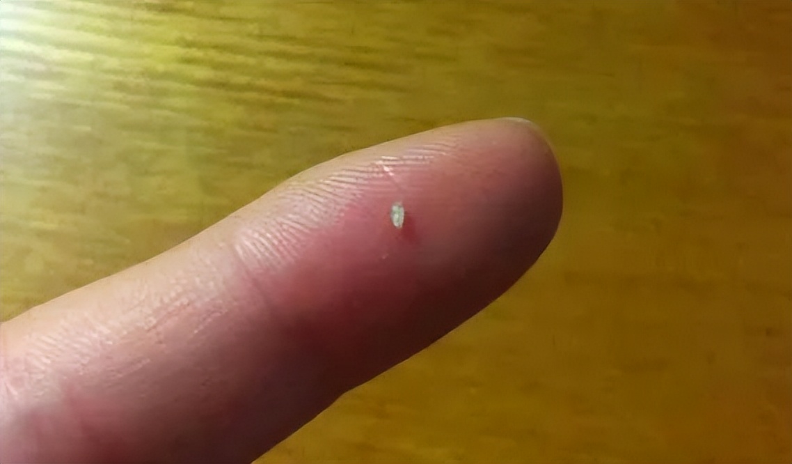 脸上挤出来硬硬的白粒,脸上白小米粒怎么回事