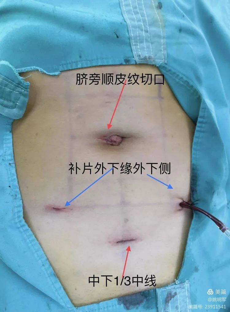 聊城市人民医院腹股沟斜疝,聊城人民医院东昌府院区疝气手术